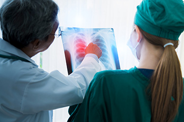Nódulos Pulmonares