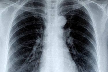 Pneumonia